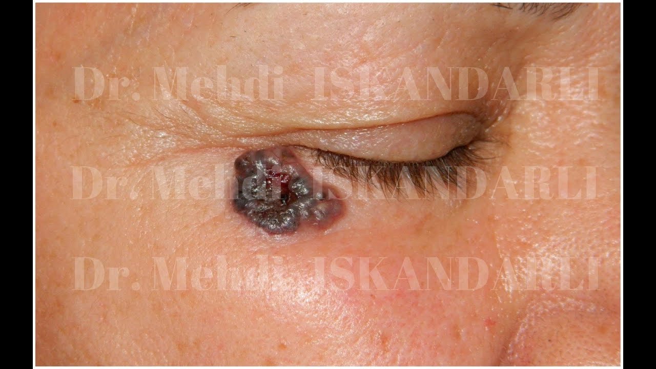 Dəri xərçəngi | Melanoma | Bazalioma | Dermatoloq Mehdi İSKƏNDƏRLİ