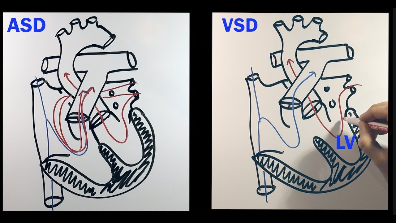 Post-operative complications: Pulmonary Hypertension