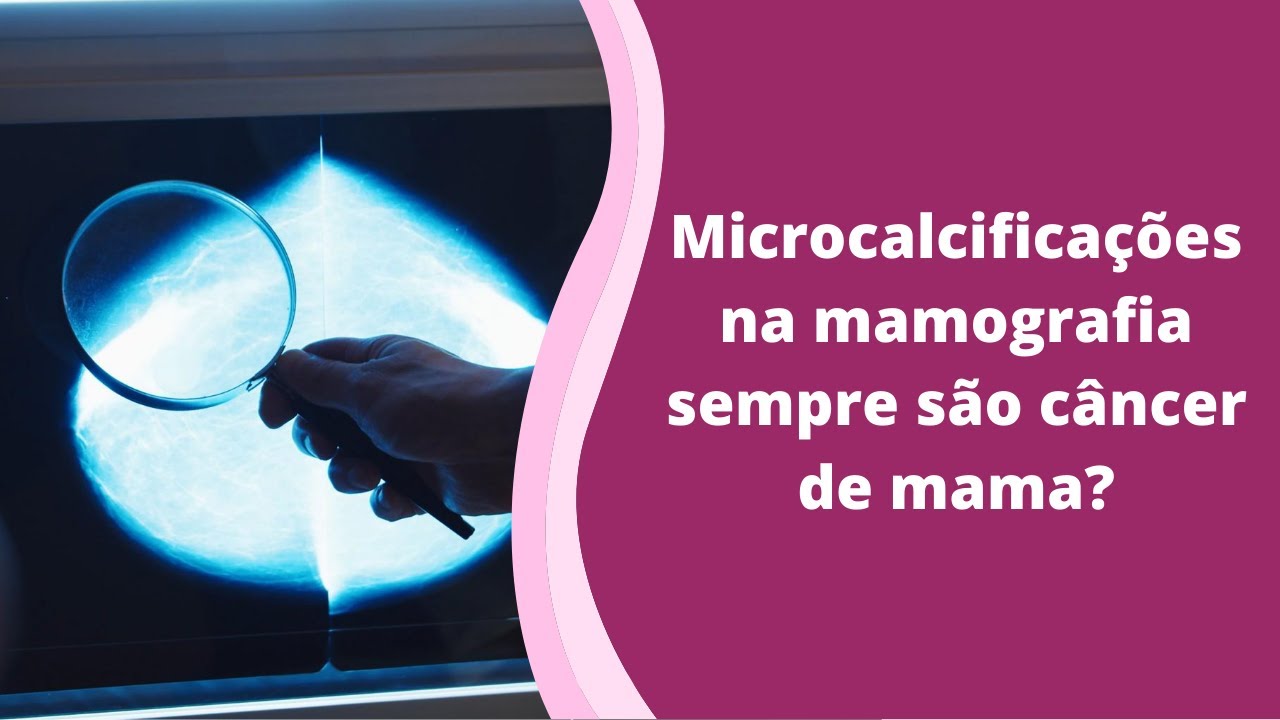 Microcalcificações na mamografia sempre são câncer de mama?