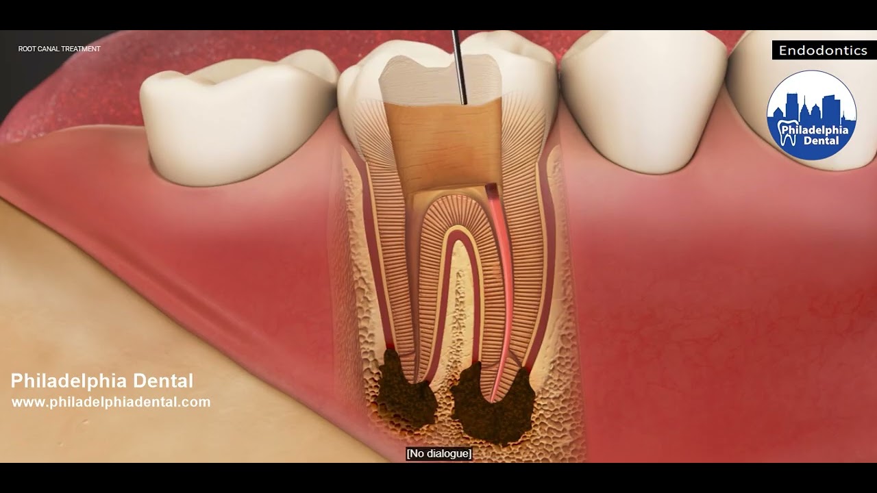 Root Canal Procedure Treatment Procedure - Philadelphia Dental
