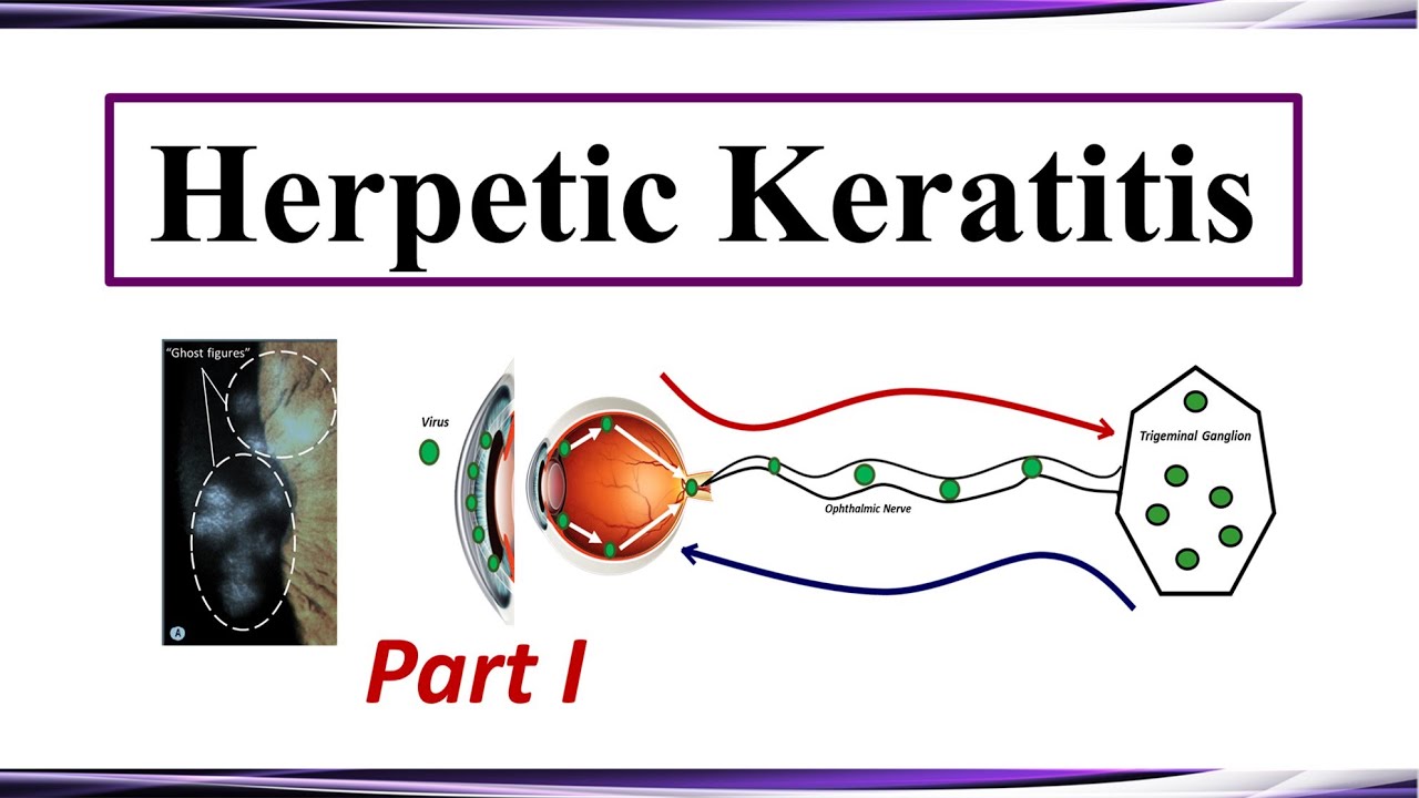 Herpetic Keratitis - Pathogenesis and Clinical Presentation (Part I)