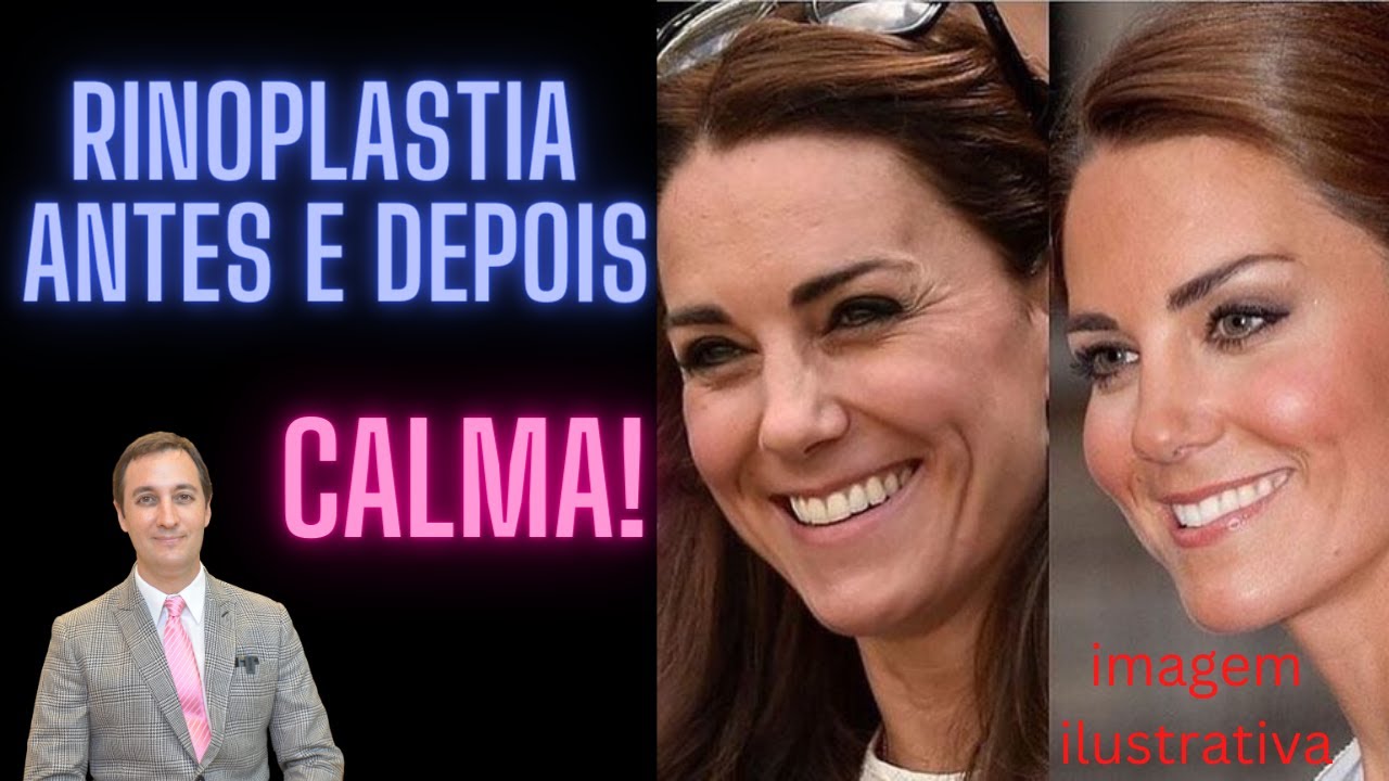RINOPLASTIA ANTES E DEPOIS