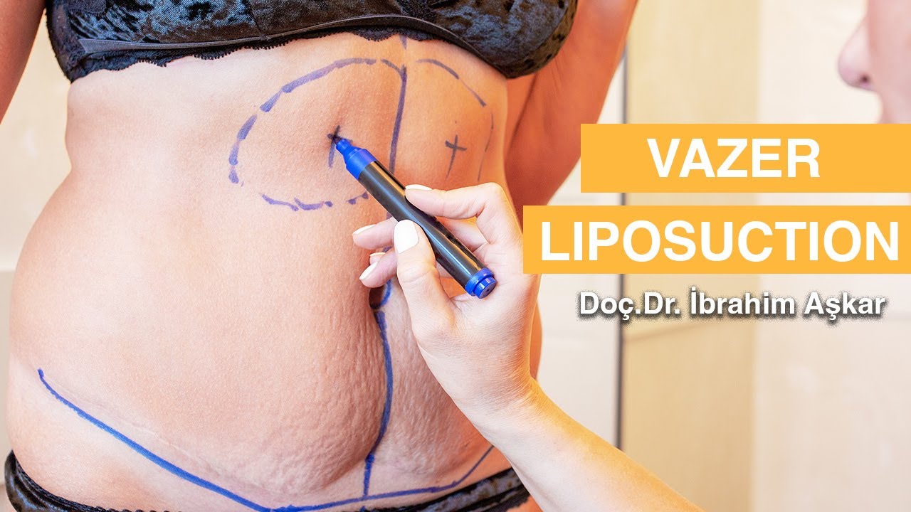 Yağ Aldırma Yöntemi - VAZER LIPOSUCTION