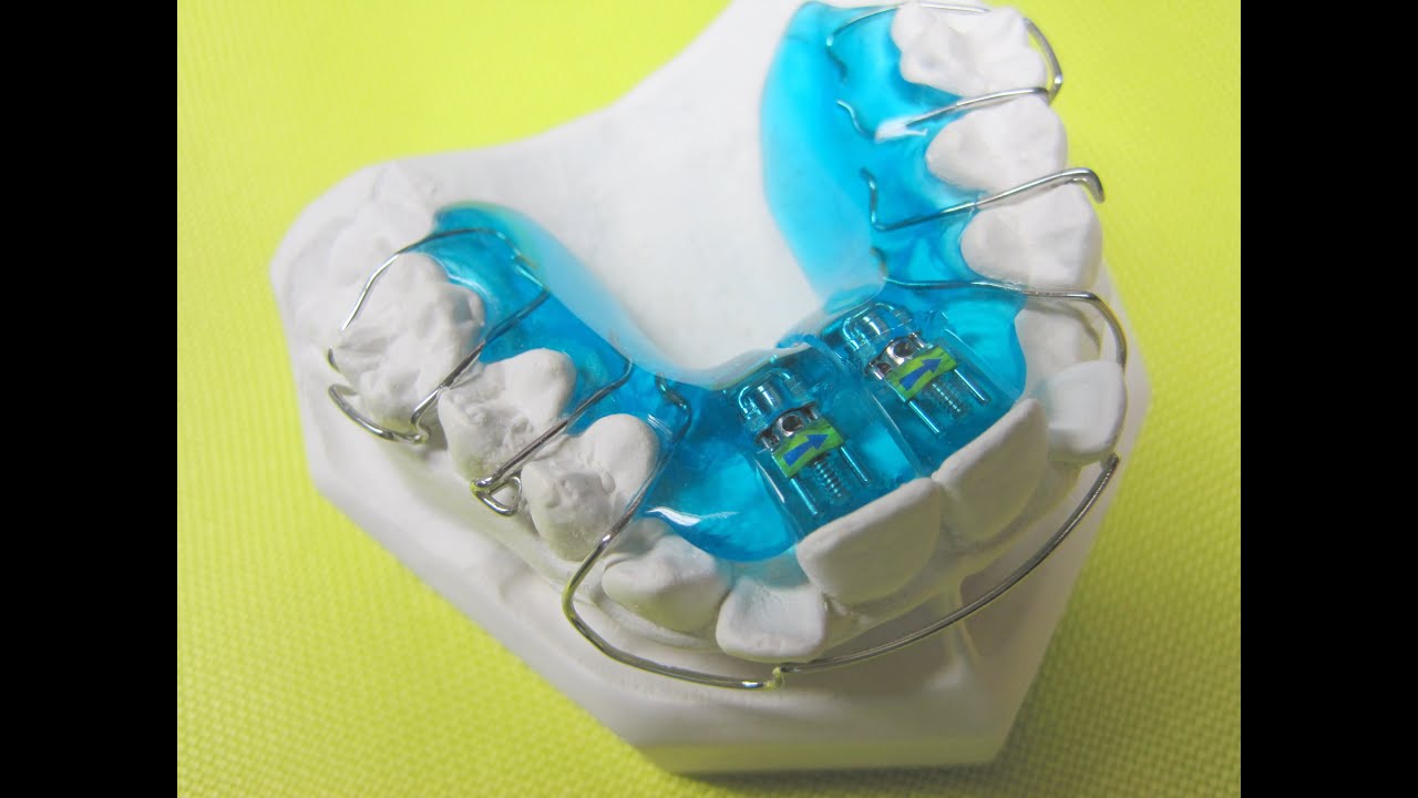Dehnplatte 4/4 Zahnspange Schwarz Retainer Active Plate Kieferorthopädie Orthodontics