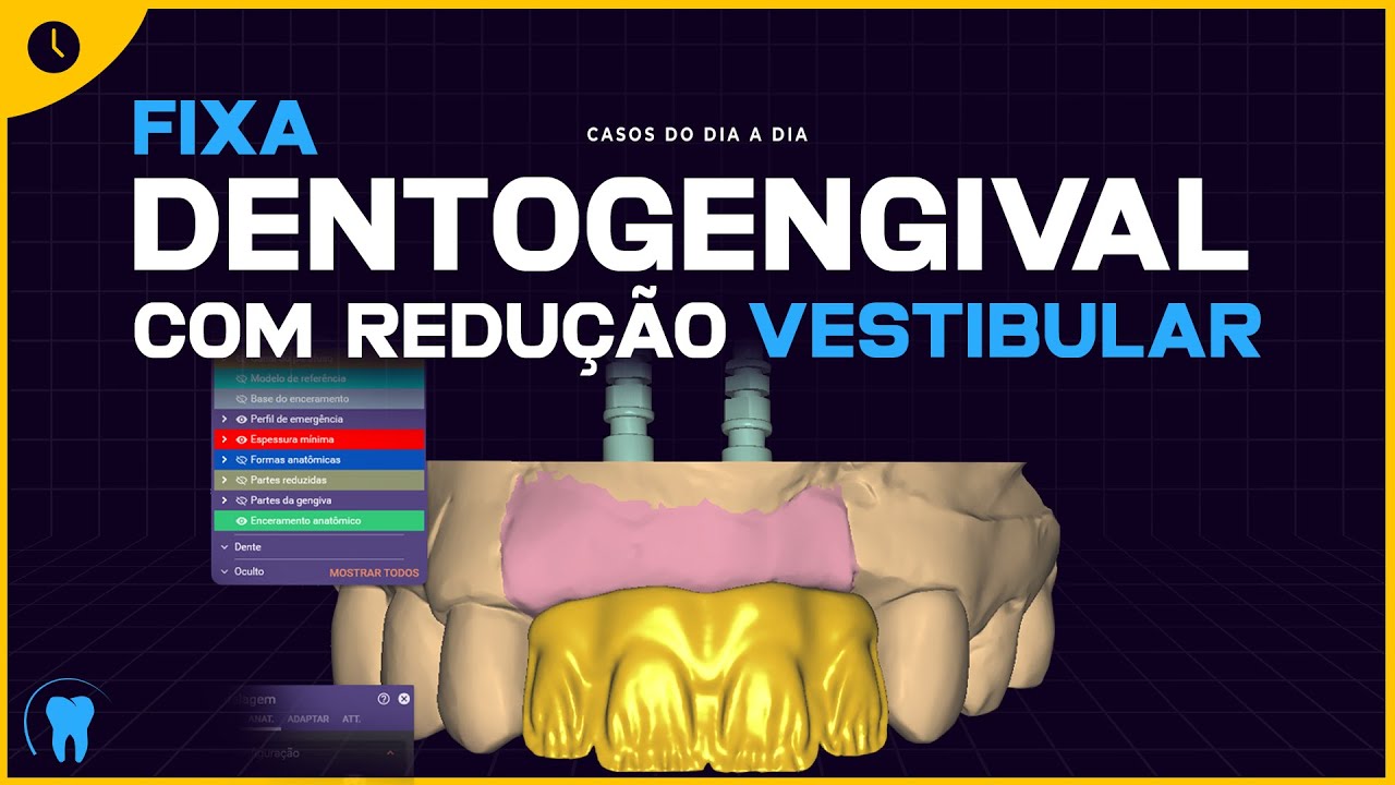 EXOCAD : Fixa dentogengival com redução vestibular sobre Implantes