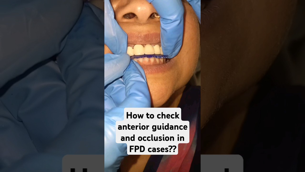 #BDS #MDS #dentistry #dental #surgery #implant  #tooth #neetmds #nbde #nbe #adc  #prosthodontic