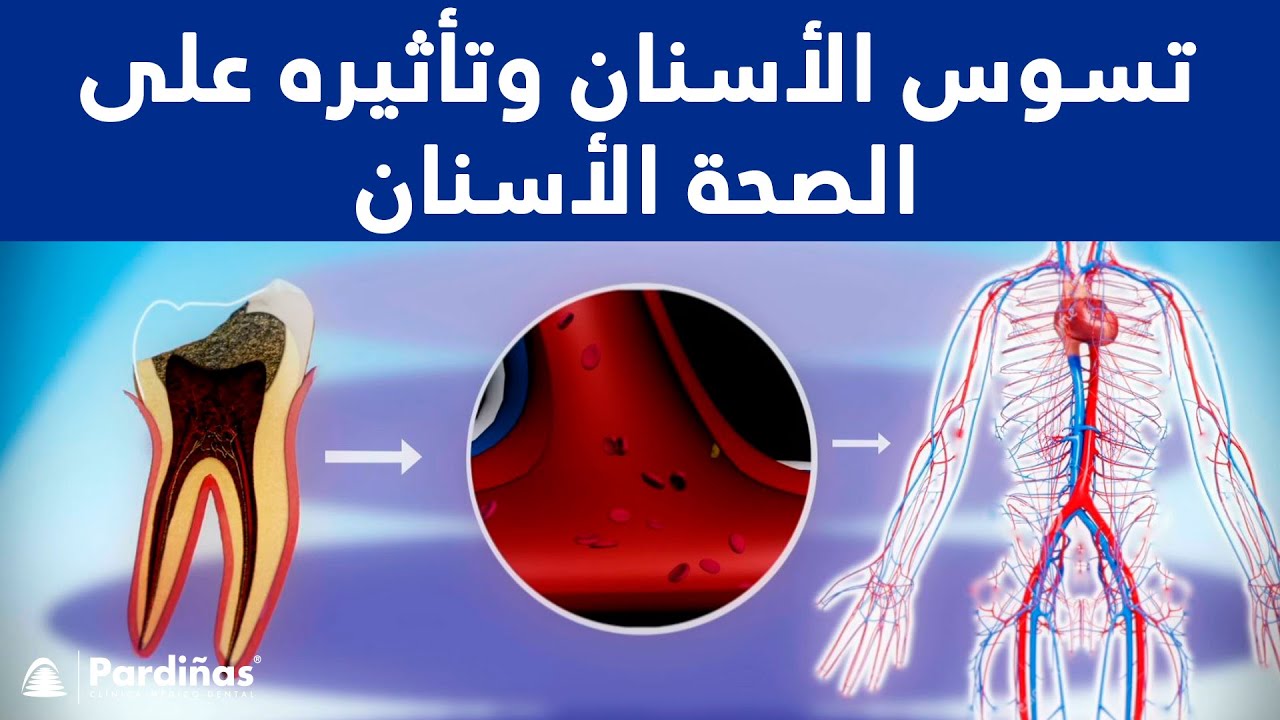 تسوس الأسنان وتأثيره على الصحة &copy;