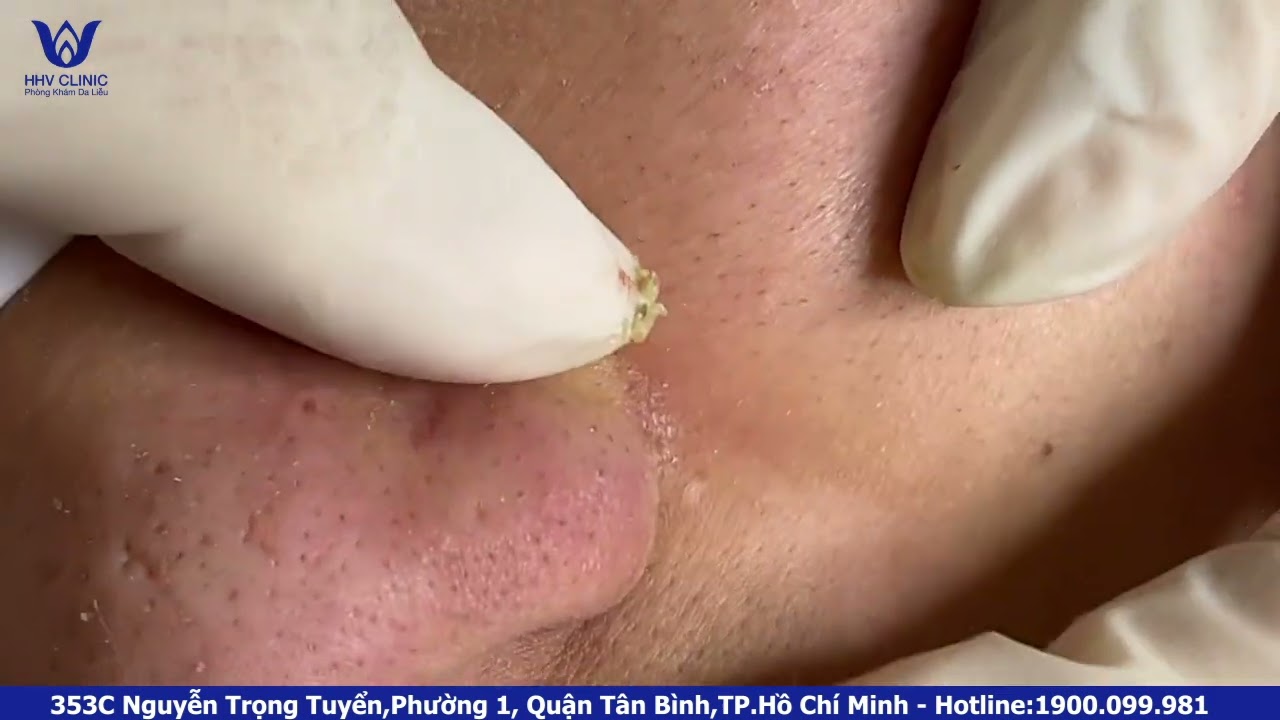 HHV Clinic | dothuhien | Acne in nose