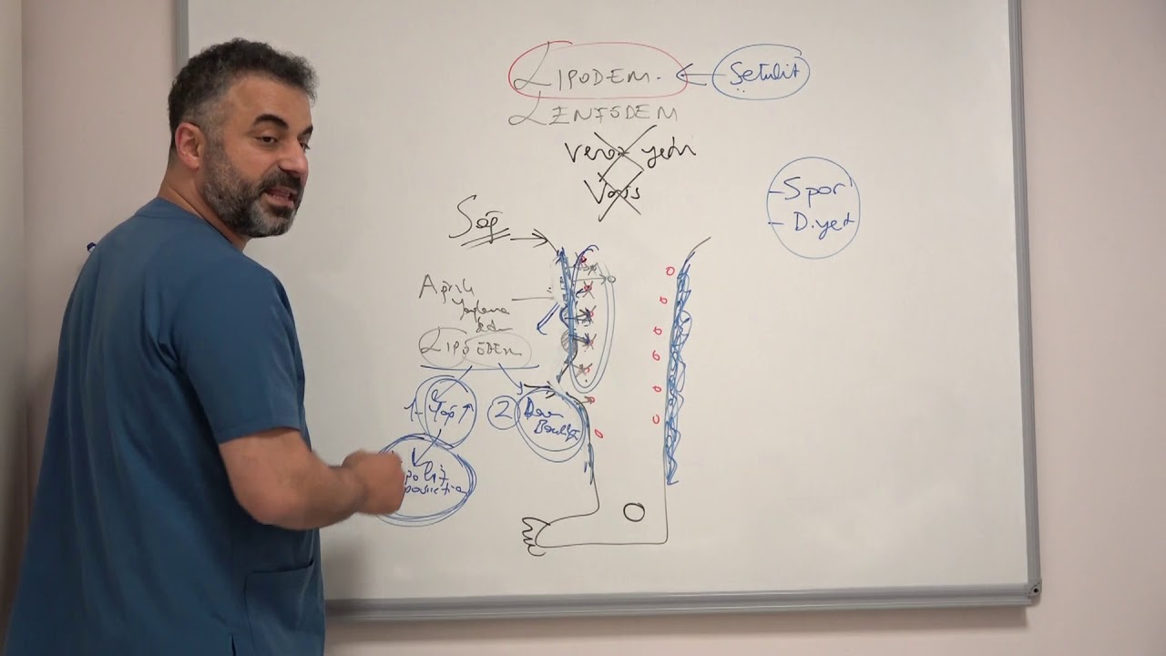 Her iki bacakta şişlik ve ağrı: Lipodem ve Lenfödem - Prof. Dr. Ahmet AKGUL