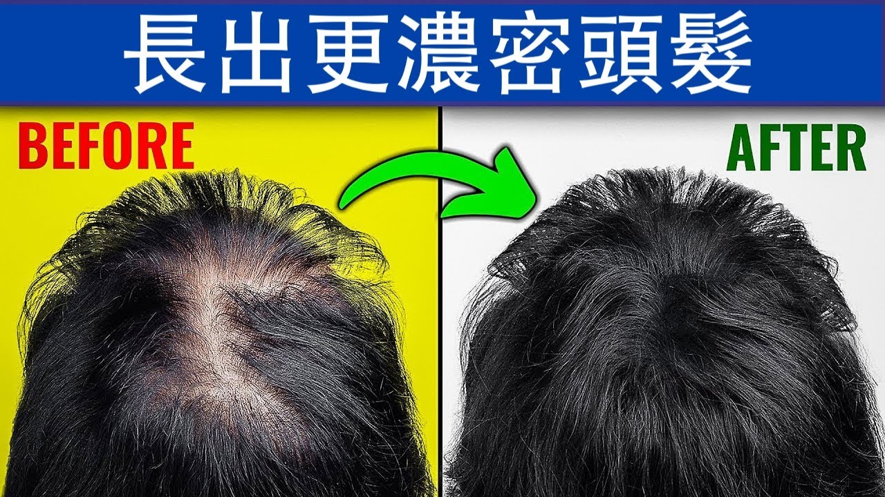 如何長出濃密頭髮?營養和秘訣,柏格醫生 Dr Berg