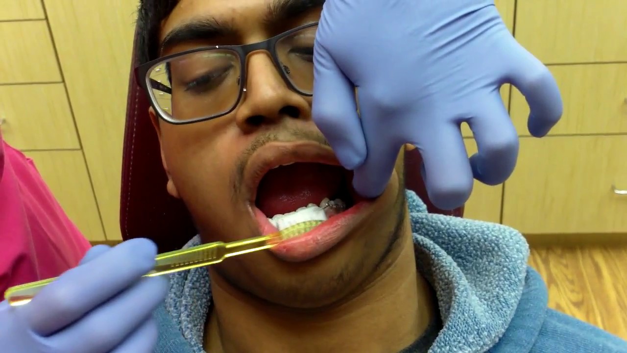 Brushing Your Braces - Banasiak & Nettune Orthodontic Associates - New Jersey