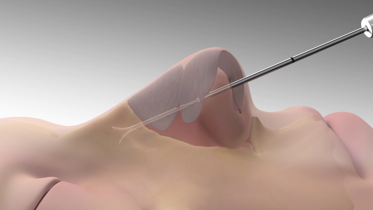 LATERA Animation for Patients with Nasal Congestion
