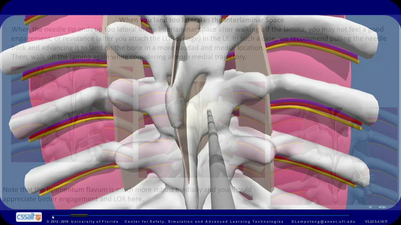 Troubleshooting for Thoracic Epidural