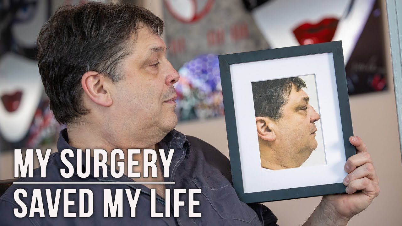 My jaw surgery to fix my sleep apnea has completely changed my life for the better