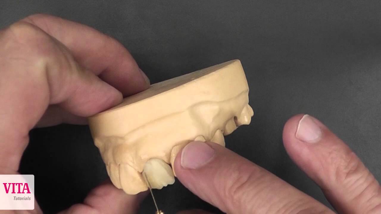 DE | Frontzahnkrone mit VITA VM LC flow | Individuelle Schichtung