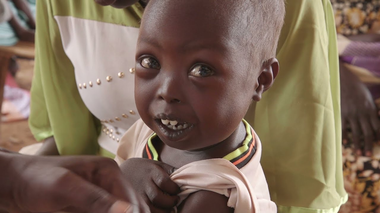 A nutrition crisis unfolding