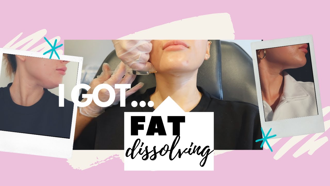 I TRIED FAT DISSOLVING INJECTIONS