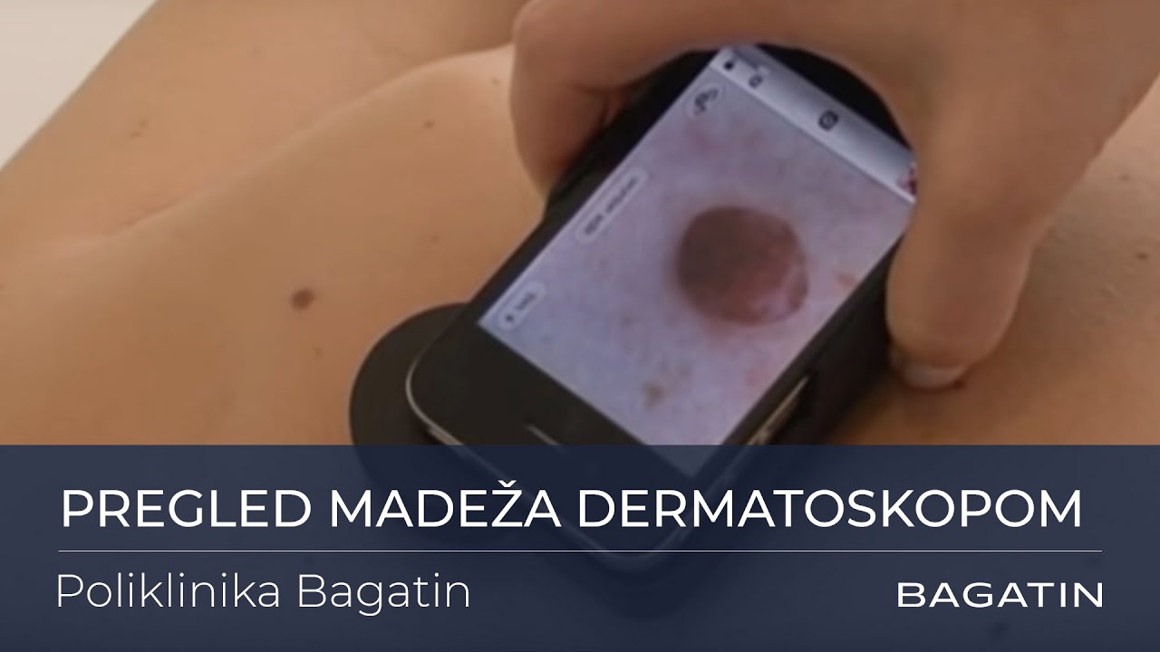 Pregled madeža dermatoskopom - Poliklinika Bagatin