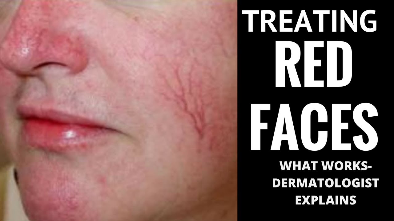 How to treat red faces