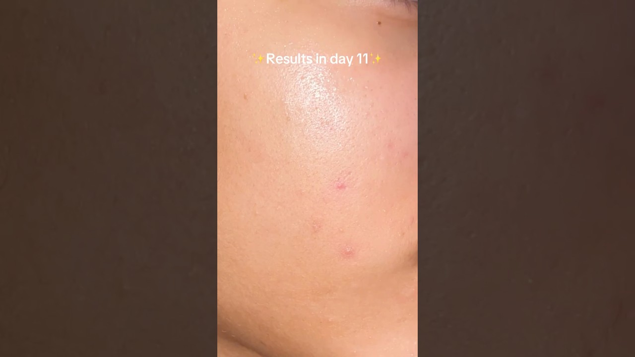 Clearing hormonal acne with Paula’s Choice 2% BHA 😭✨ | Skincare Journey