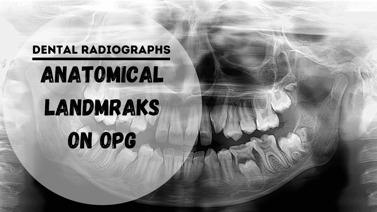 Dental panoramic radiographs | OPG  | DPT  Anatomical Landmarks