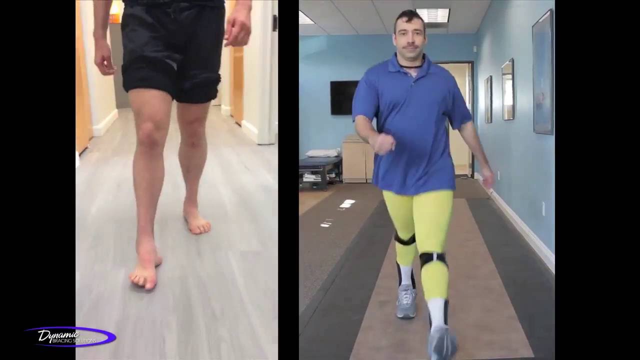 Charcot-Marie-Tooth: DBS Braces: Before & After #2