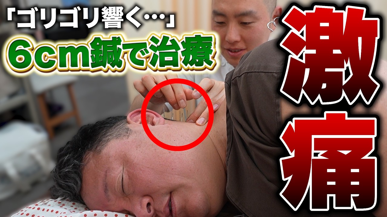 【首痛】耐え続けて30年&hellip;｜6cm鍼で救済【鍼灸】