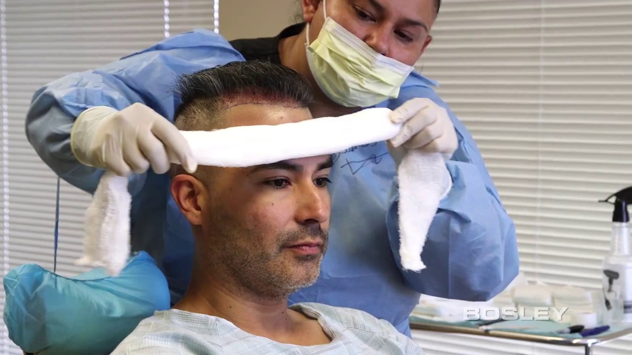 Edgar’s FUE Journey: Step-by-Step Hair Restoration