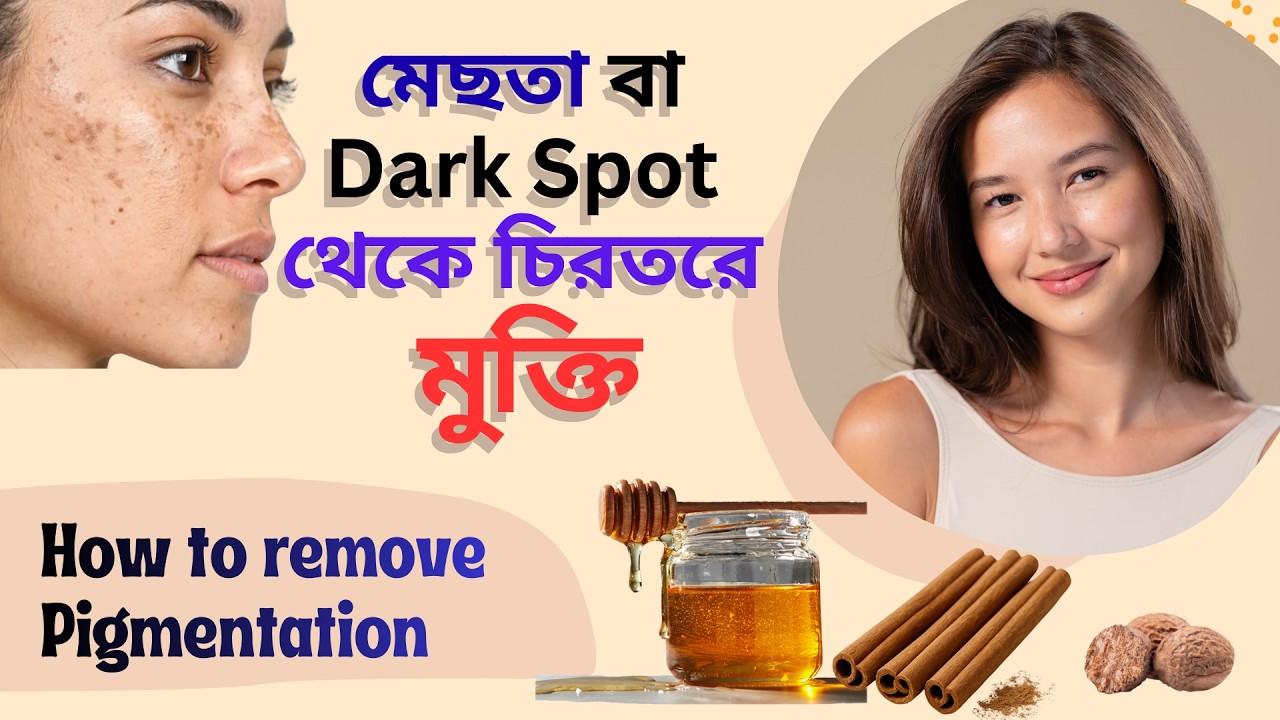 মেছতা থেকে চিরতরে মুক্তি। Home remedies for Acne, Dark spot and Pigmentation