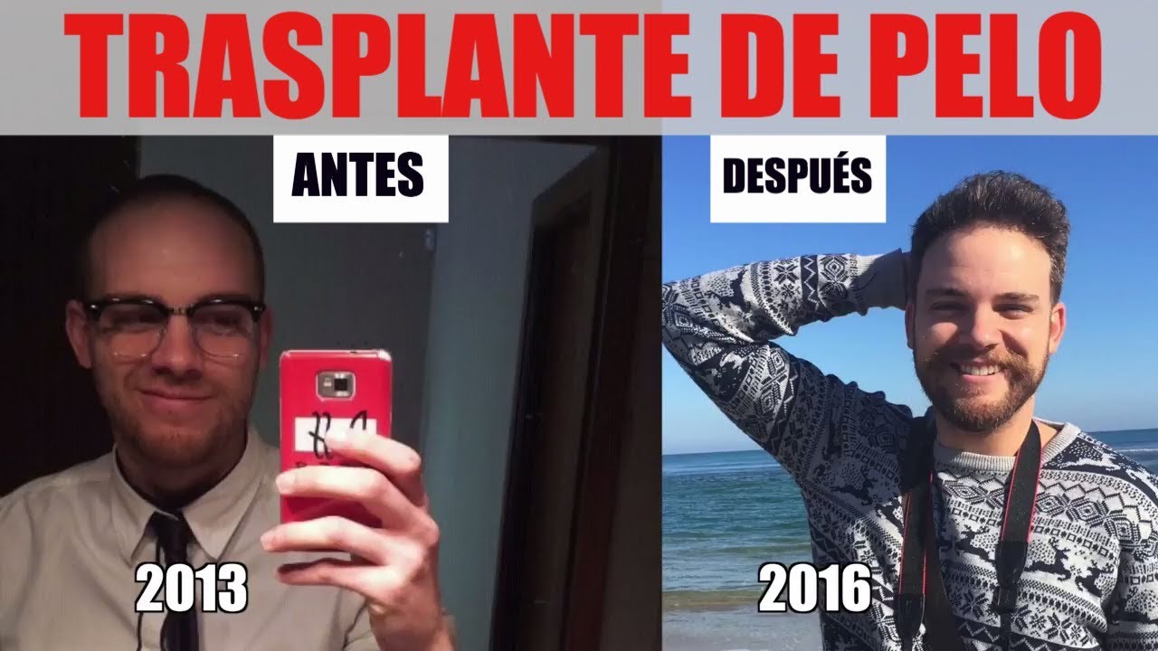 15 DÍAS DESPUÉS DEL TRASPLANTE DE PELO: Qué podemos esperar y efectos.