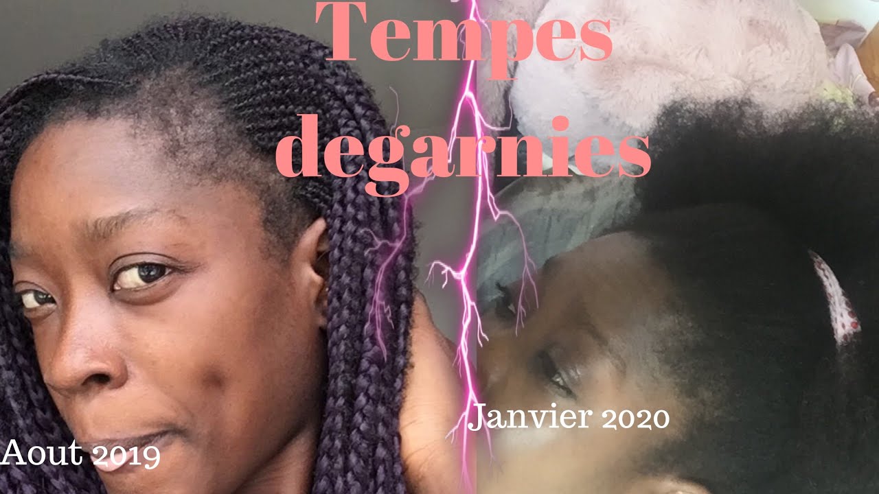 ALOPÉCIE : COMMENT J’AI FAIT REPOUSSER MES CHEVEUX DES TEMPES RAPIDEMENT ? AGIS DIRECTEMENT  !