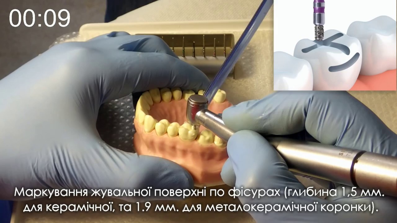 Препарування зуба під коронку за 10 хвилин системою CCQ від доктора Андрія Завадки.