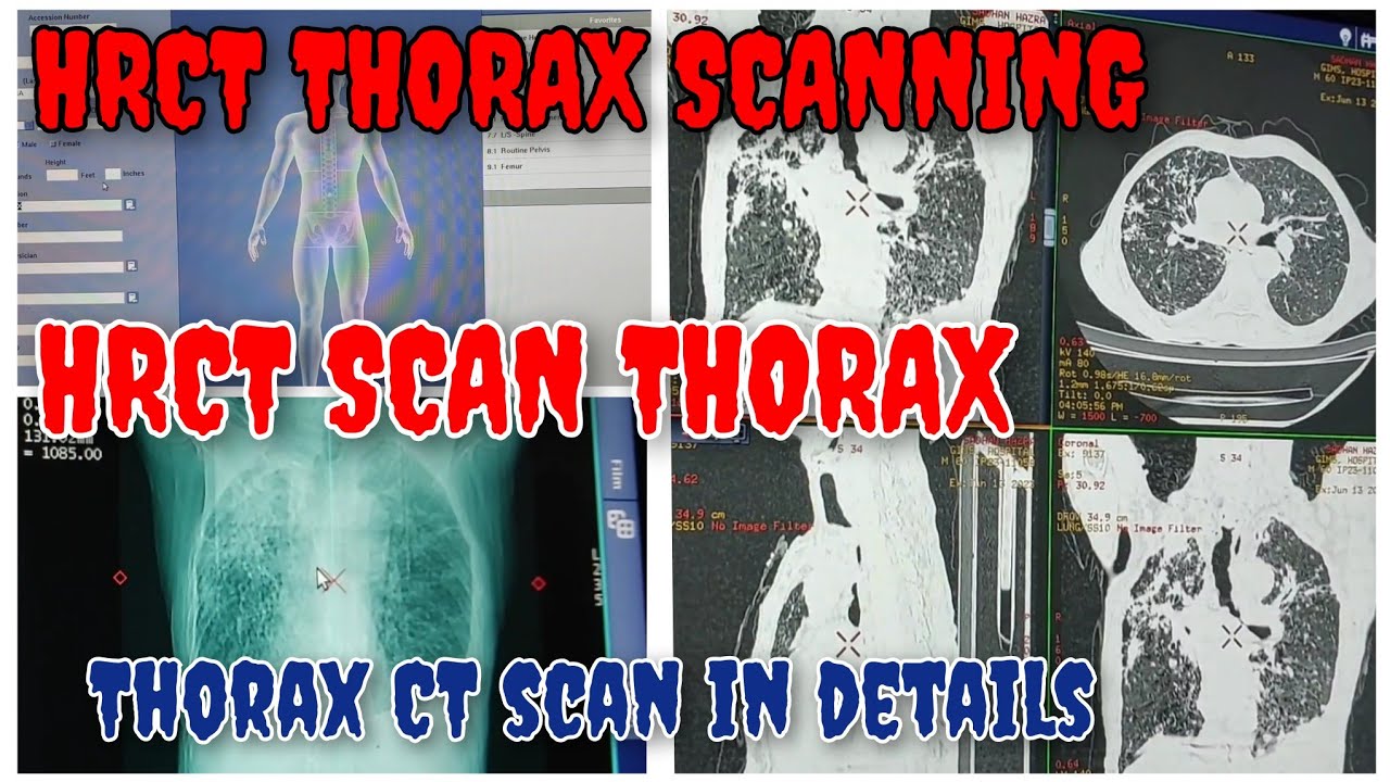 How to do HRCT Thorax || HRCT Thorax full scanning details || High Resolution Computed Tomography