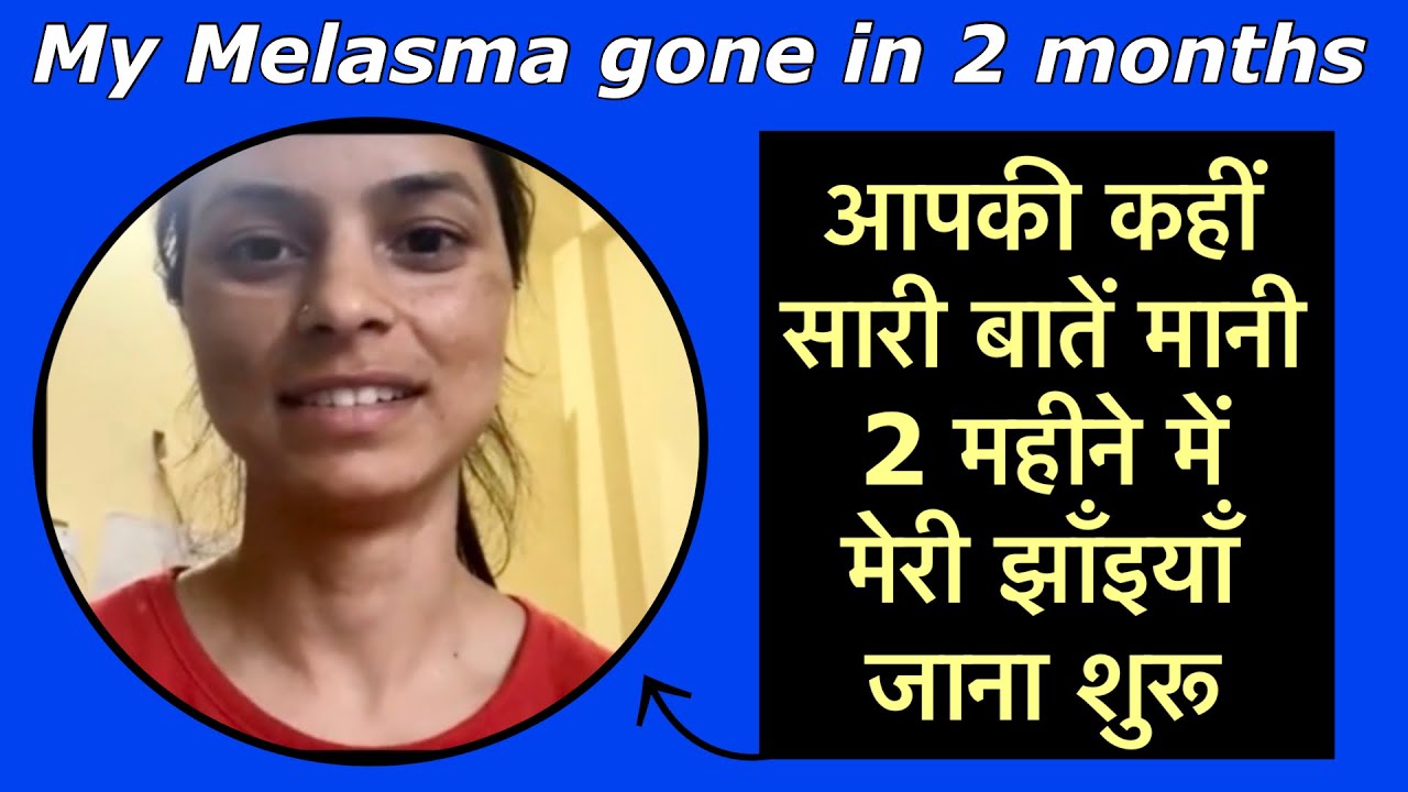 My Melasma gone in 2 months. आपकी कहीं सारी बातें मानी 2 महीने में मेरी झाँइयाँ जाना शुरू