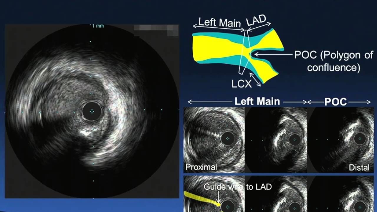 Left Main Bifurcation Lesion