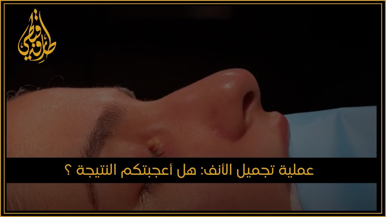 مركز الدكتور طارق قبطي للتجميل | عملية تجميل الأنف أجريتها في الكويت
