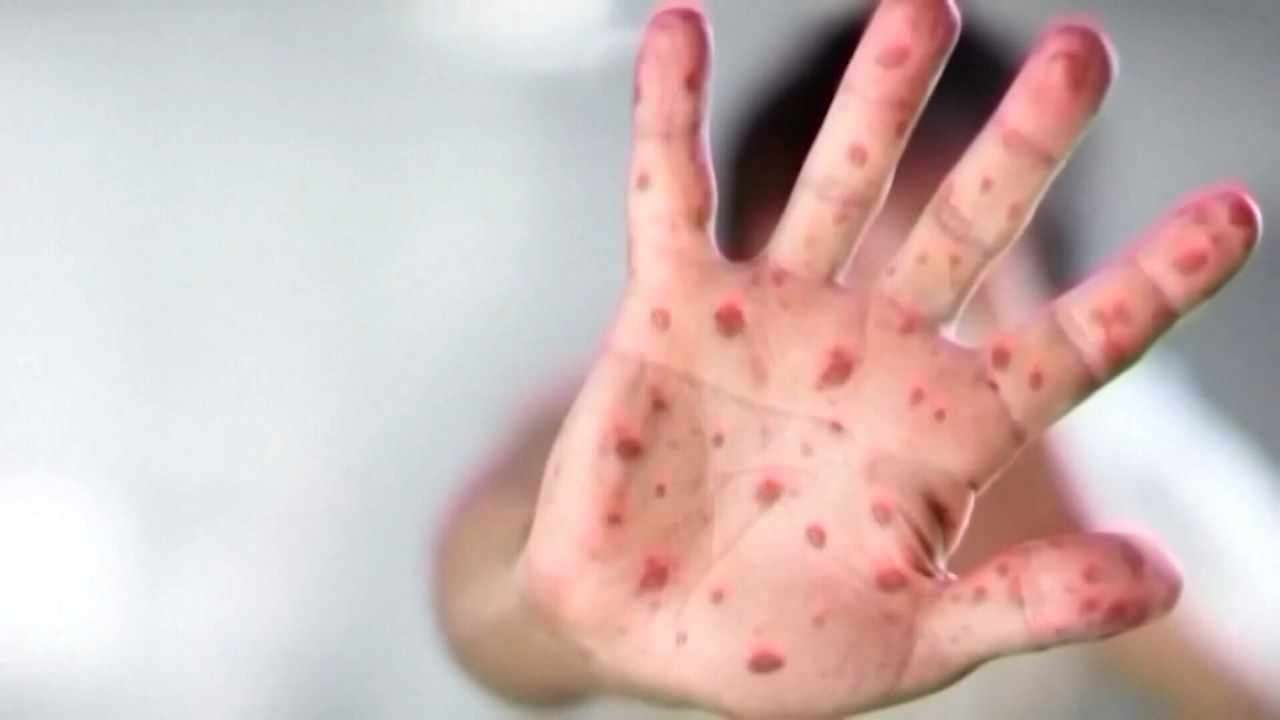 В Сан-Франциско зафиксирован первый случай кори с 2019 года: незащищенный младенец контактировал ...