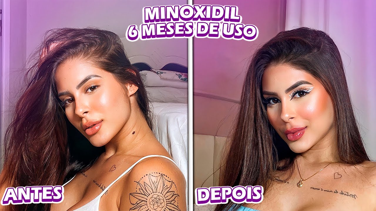 MINOXIDIL (6 MESES DE USO) - EFEITOS COLATERAIS, APLICAÇÃO e +