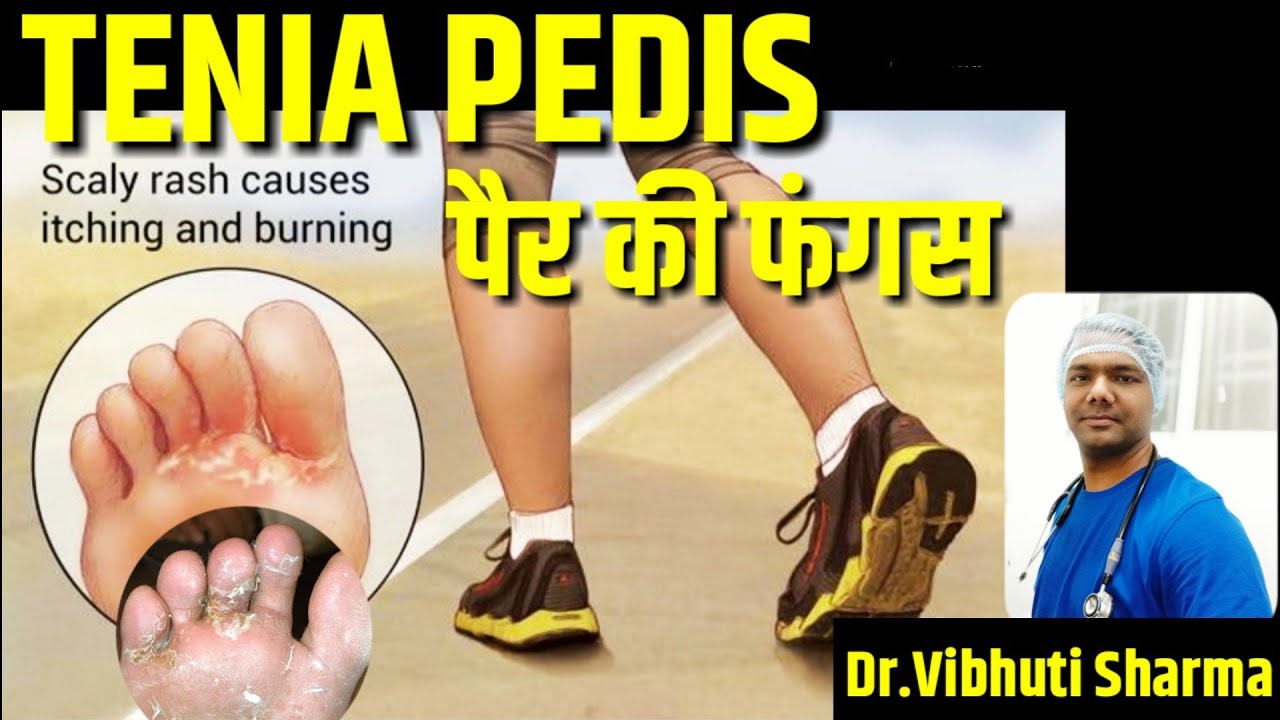 TINEA PEDIS,Fungal infections,SCIATICA  -Dr Vibhuti Sharma BHMS,PGHom(London) Homeopathy Physician.