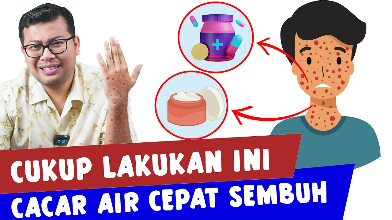 GEJALA PENYEBAB DAN CARA MENGATASI CACAR AIR - DOKTER SADDAM ISMAIL