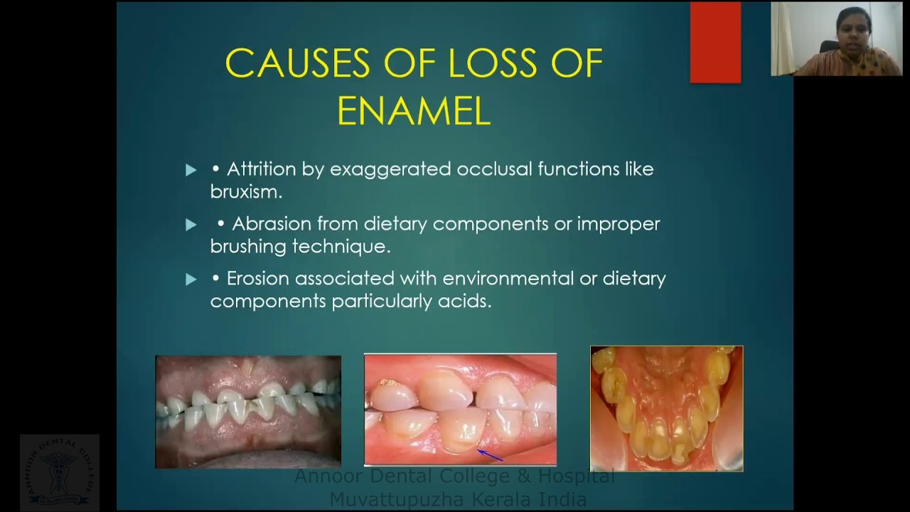 Dental Hypersensitivity