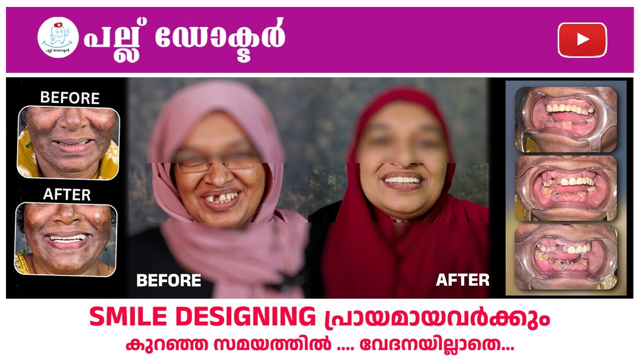 Smile Designing - പ്രായമായവർക്കും .... കുറഞ്ഞ സമയത്തിൽ .... വേദനയില്ലാതെ...