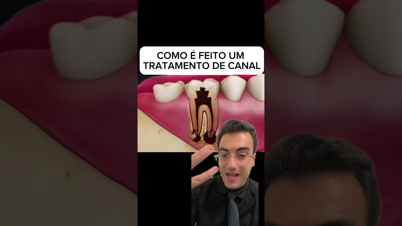 Como &eacute; feito um tratamento de canal. #odonto #tratamentodecanal #endodontia