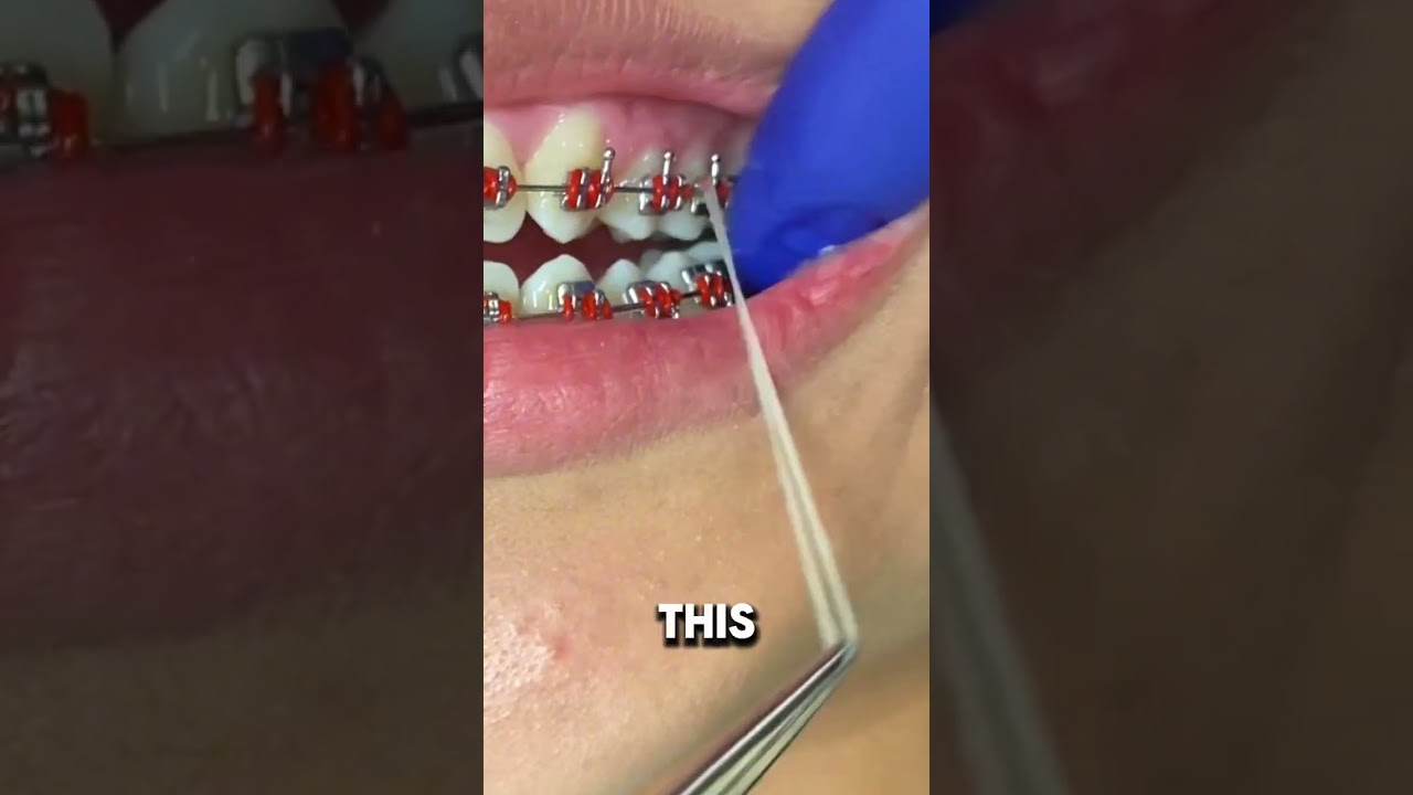 Модели ортодонтических эластиков (резинок) и почему их нужно носить &mdash; Toothtime