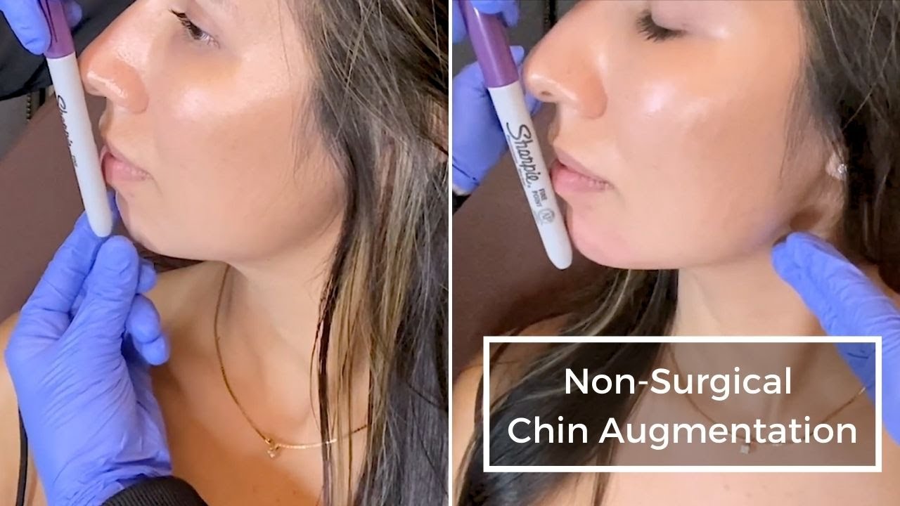Chin Augmentation With Restylane Defyne at Omaha Cometic Center by Imagen