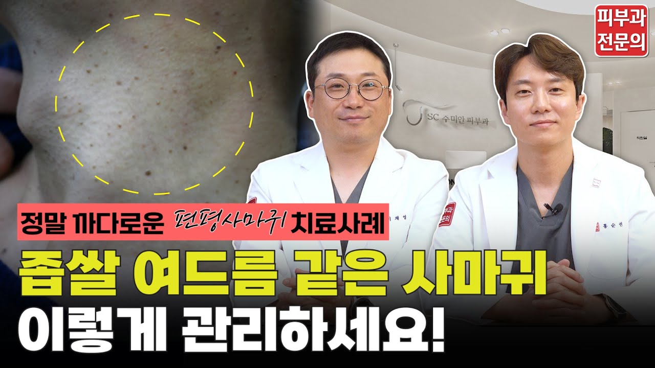 피부과전문의가 알려드리는 편평사마귀치료 총 정리!!