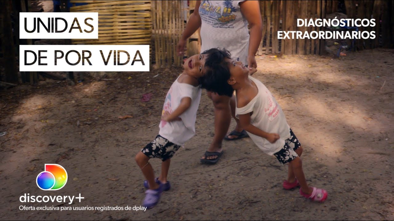 Así es la vida de estas dos siamesas cuyos cráneos están fusionados| Diagnósticos extraordinarios