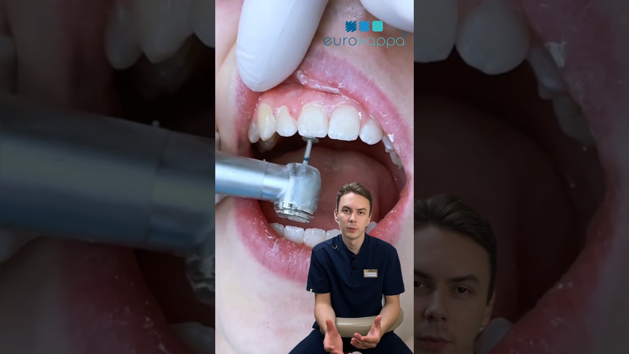 Шлифовка зубов🦷 #eurokappa #еврокаппа #зубы #улыбка #элайнеры #брекеты #ортодонт