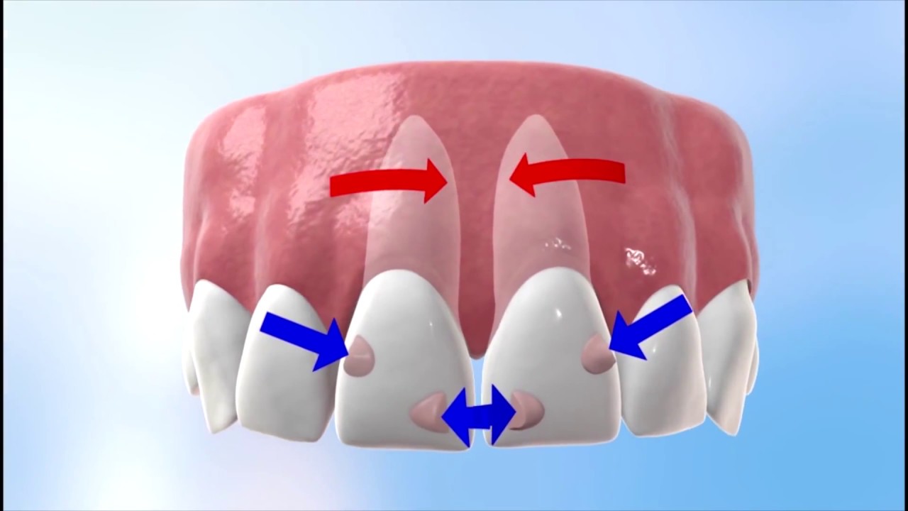 Discover how Invisalign works