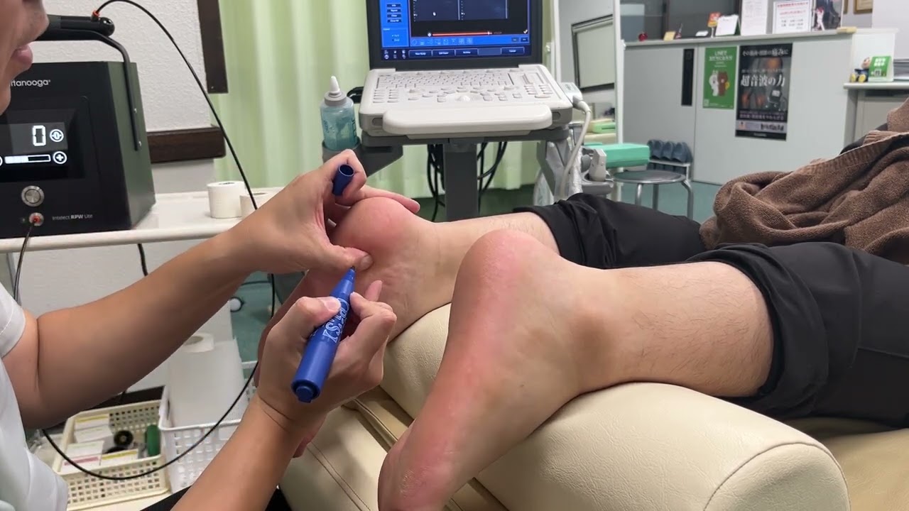 大分市 足底腱膜炎 踵・足裏の痛み 圧力波（拡散型衝撃波）療法｜大分ごとう整骨院